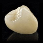 Cercon Zirconia Crown