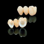 Zirconia Bridge