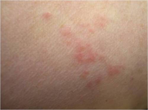 bed bug bite pictures