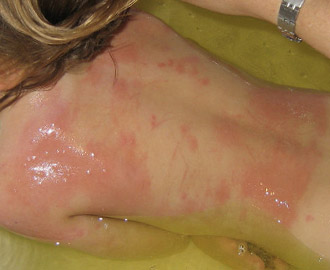 bed bug erythema on back