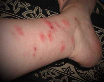 bed bug bites on leg