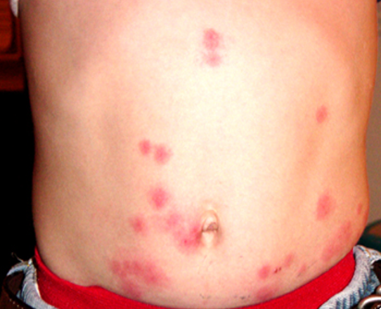 bed bug bites on stomach