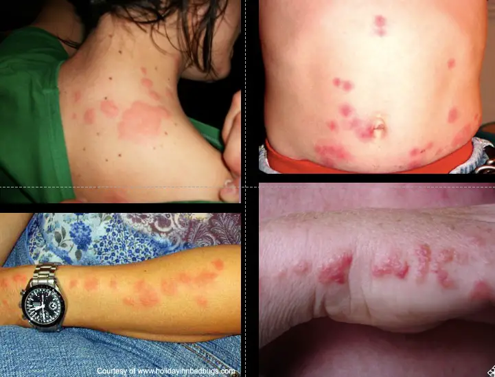 bed bug bite symptoms