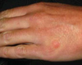 bed bug bite on hand