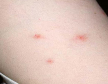 Bed Bug Bites in a Triangle Pattern