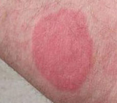 Bed Bug Wheal Reaction