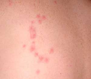 bed bug bites in a circle pattern