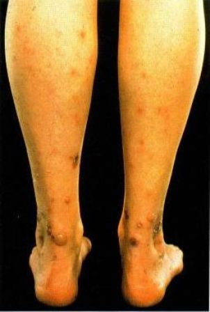 flea bites on legs - example - 302px x 448px