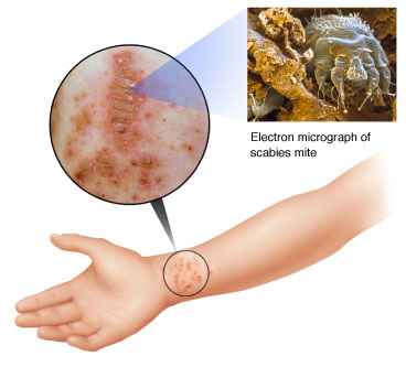 scabies mite bite rash