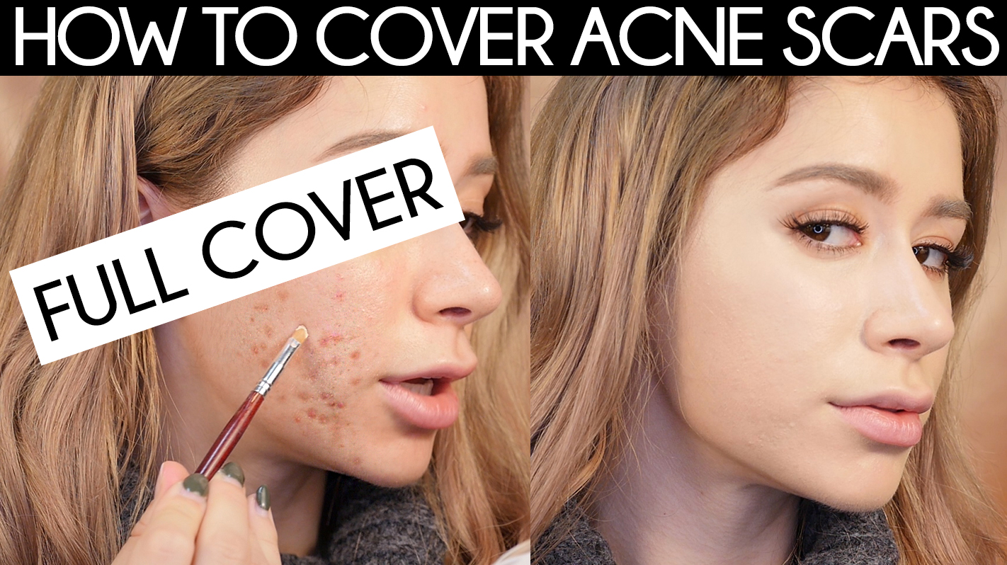 HOW TO COVER ACNE SCARS