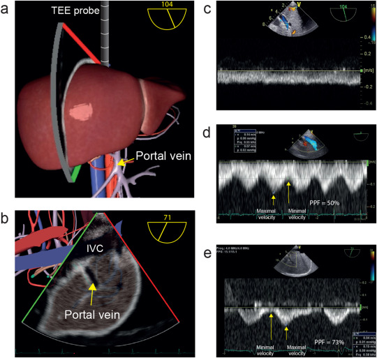 Portal Vein Thrombosis Ultrasound