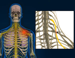 Long Thoracic Nerve Compression