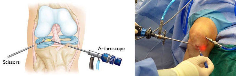 Knee Artroscopy