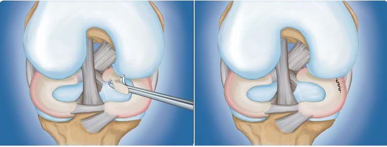 Meniscus Repair