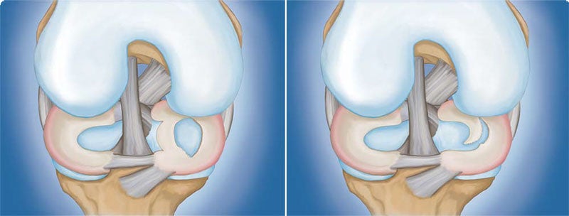 Meniscus Tear: (Left) Bucket handle tear. (Right) Flap tear