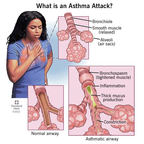 Asthma: What You Need to Know