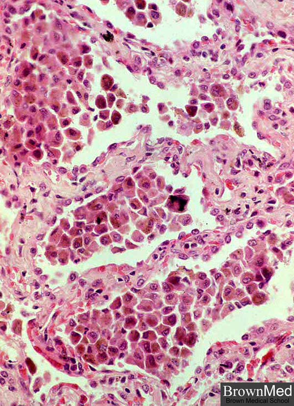 Interstitial Lung Disease Histology