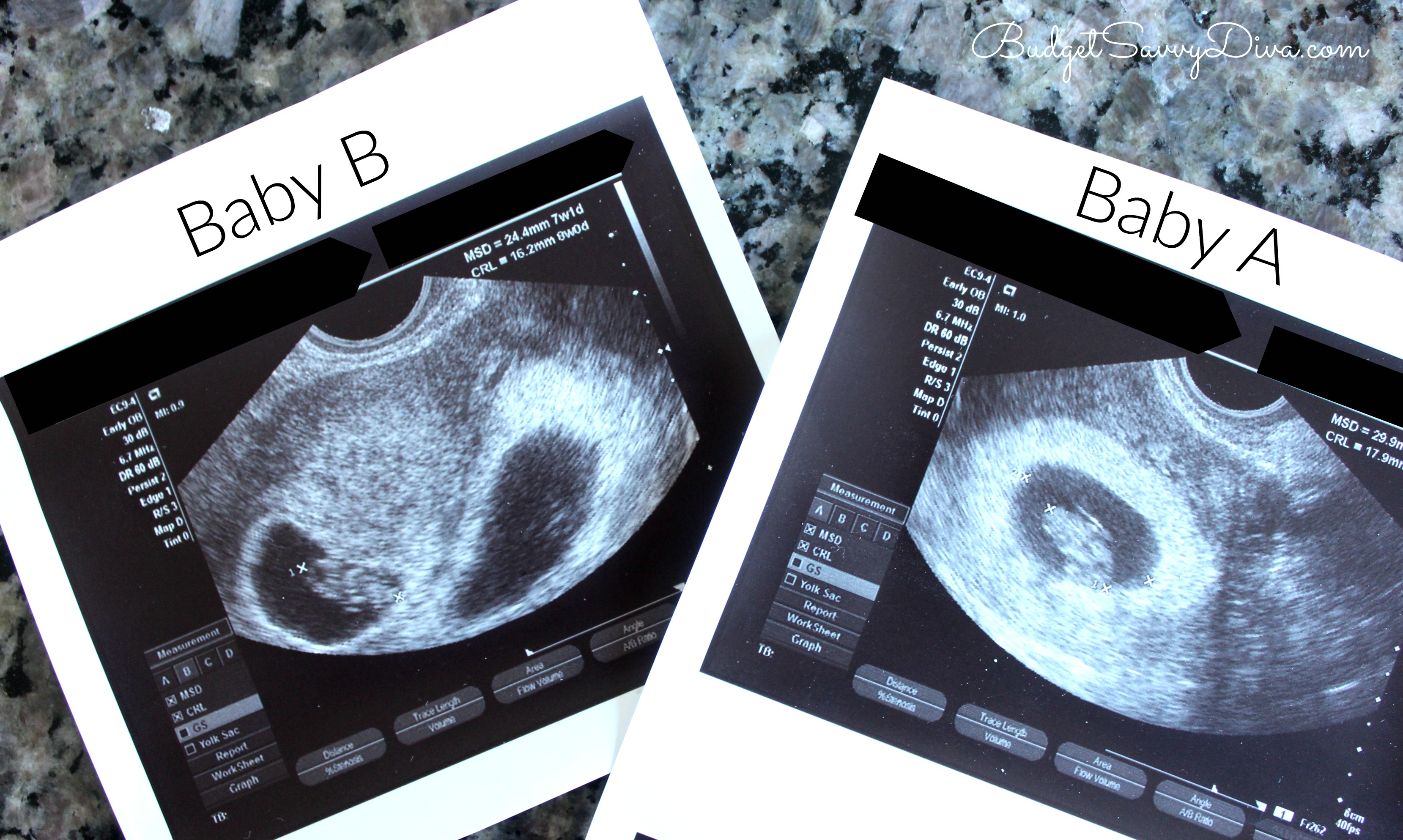 9 Weeks Pregnant Ultrasound Twins