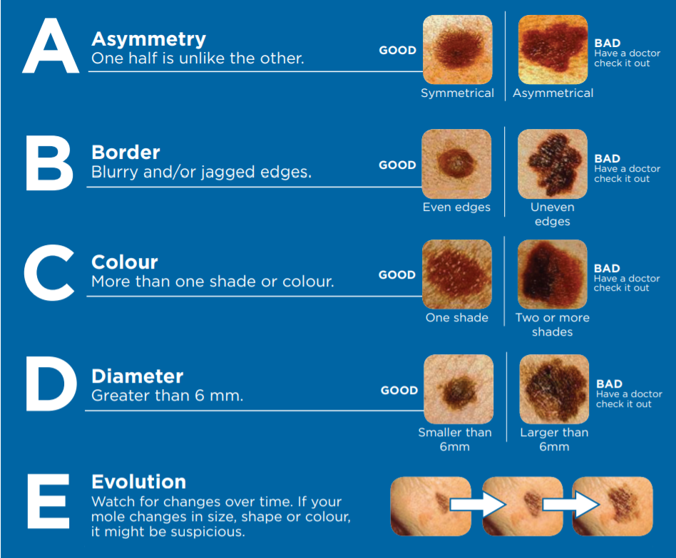 Abcde Rule Of Skin Cancer Quizlet at Joshua Wydra blog