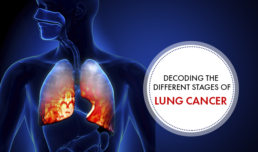 DECODING THE DIFFERENT STAGES OF LUNG CANCER | Cancer Healer Center