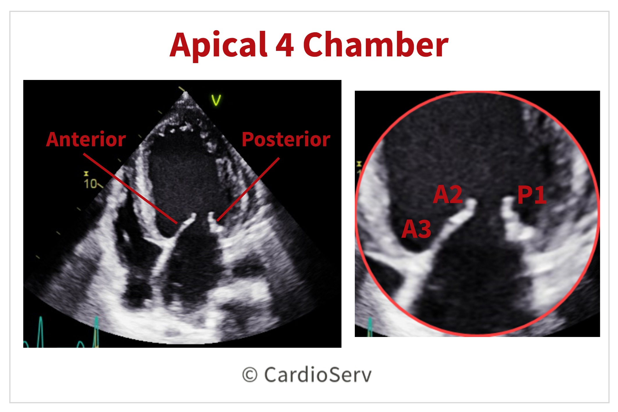 Normal Mitral Valve Echo