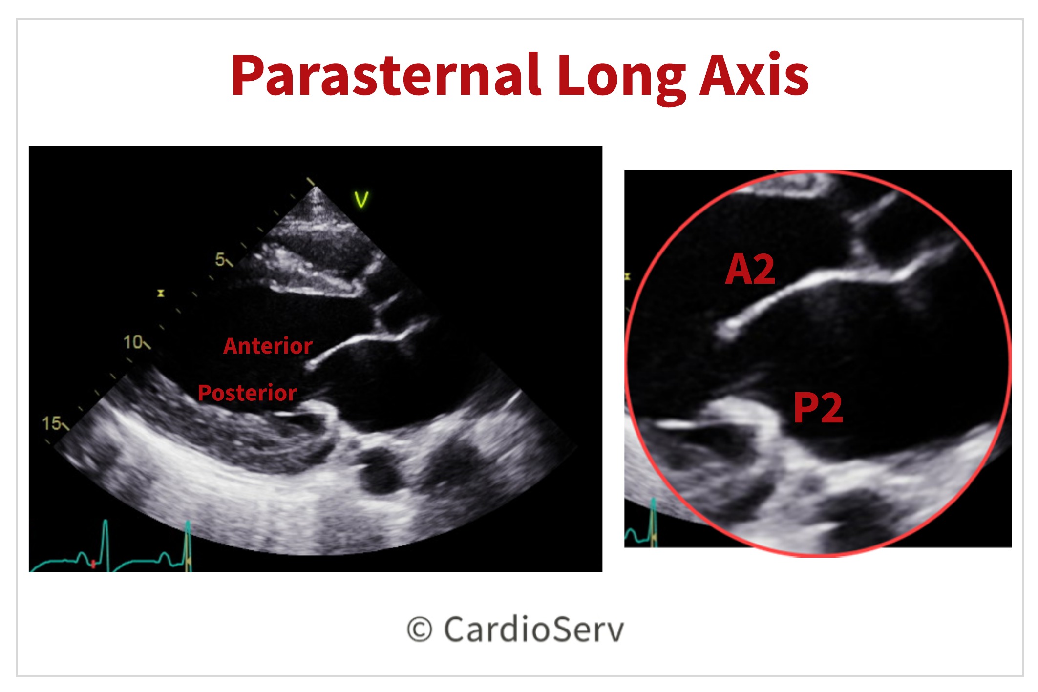 Normal Mitral Valve Echo