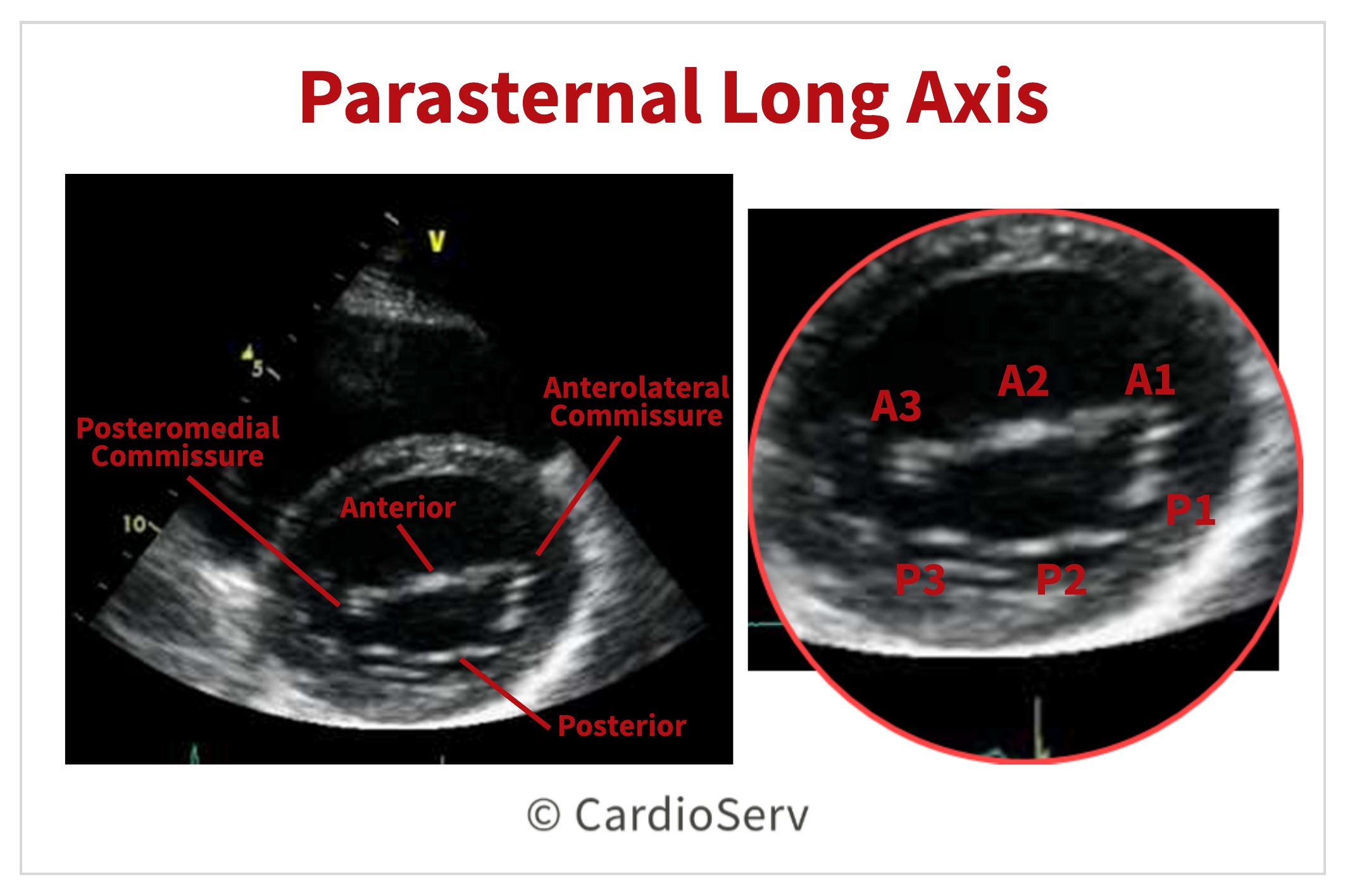 Normal Mitral Valve Echo