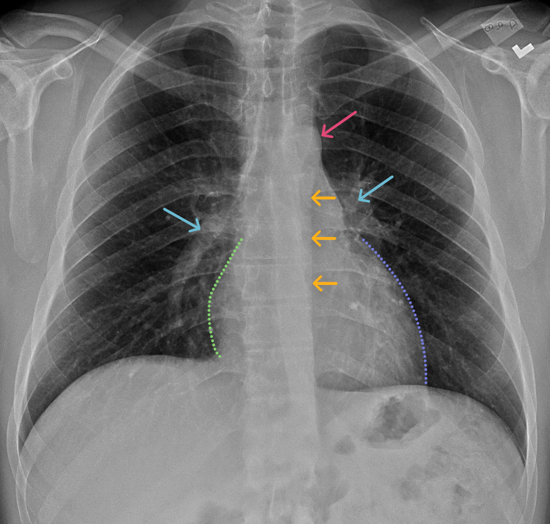 Normal Chest X Ray Labeled