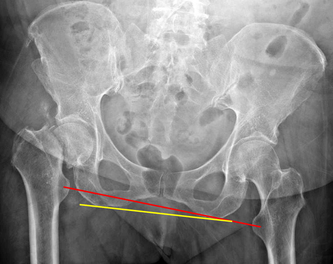 Transcervical Femoral Neck Fracture