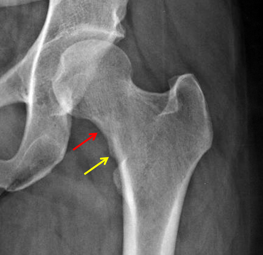 Normal hip xray femoral neck fracture xray - ctmens