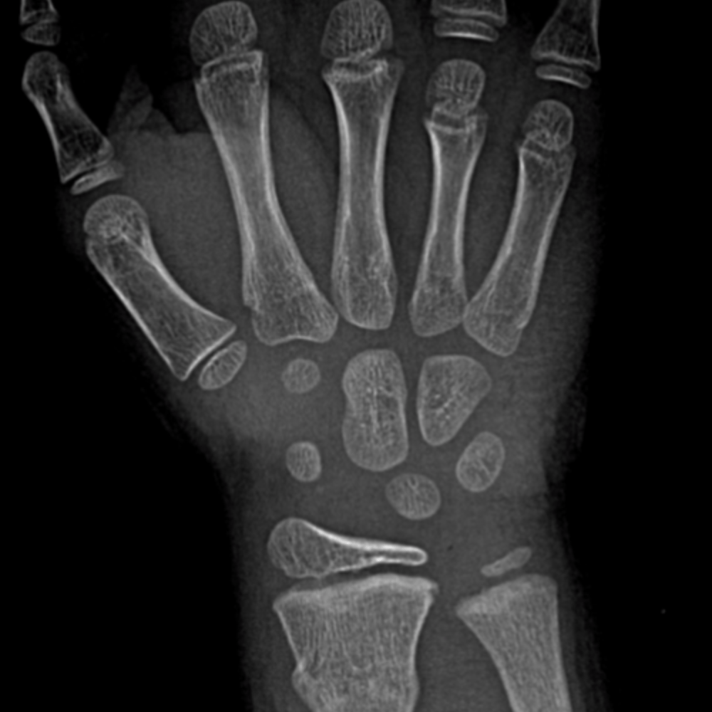 Top 93+ Pictures Normal X-ray Of Hand And Wrist Sharp 10/2023