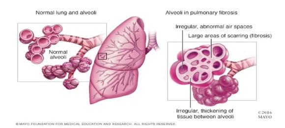 September is Pulmonary Fibrosis Awareness Month