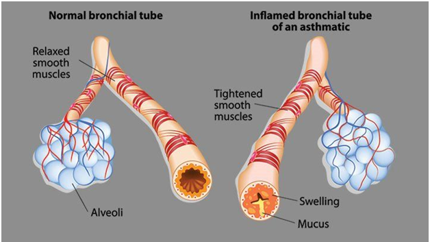 Permanent Cure for Asthma in Ayurveda