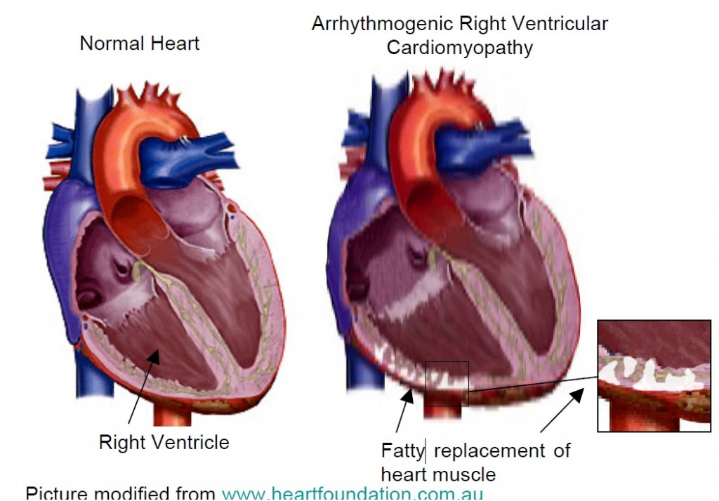 Arrhythmogenic Right Ventricular Dysplasia