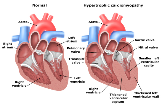 Hypertrophic Cardiomyopathy (HCM) – CIDG