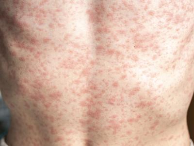 Measles rash