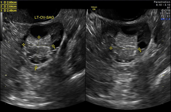 Ovarian Cyst Simple Vs. Complex Hotsell | cdlguaiba.com.br