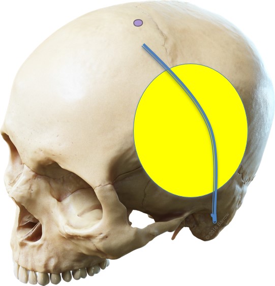 Temporoparietal Craniotomy for Epidural Hematoma - cns.org