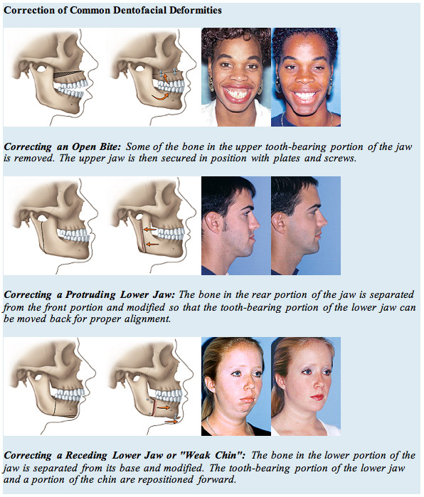 Orthognathic Surgery | Clark & Patel Oral Surgery