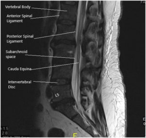 Case Study: Management of 50-year-old male with Cauda Equina Syndrome