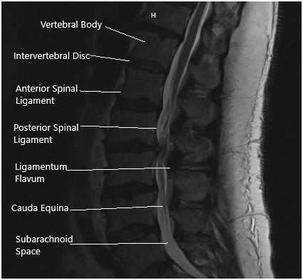 Case Study: Lumbar Stenosis Management in 60 Year Old Female