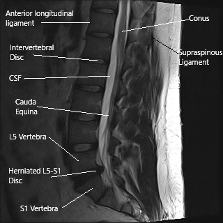 Surgical Treatment of Sciatica of Lumbar - Complete Orthopedics