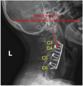 Case Study: Anterior Cervical Discectomy and Fusion C3 TO C6