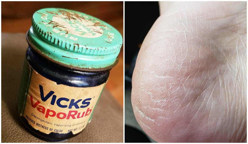 11 Ways To Use VapoRub That Aren’t What It Was Made For