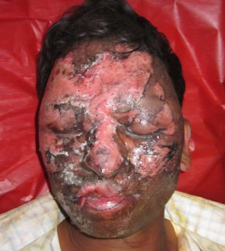 a patient with substantial facial burns, swelling, enlarged lips and nose