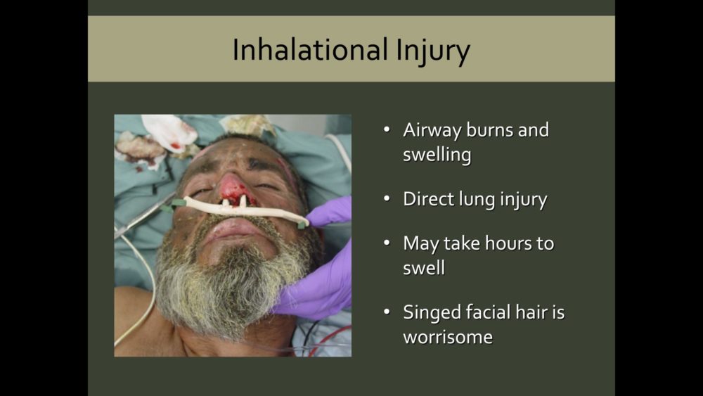 A slide from the Burn section of CM online courses, including issues for inhalation, showing a photo of a burn victim on O2