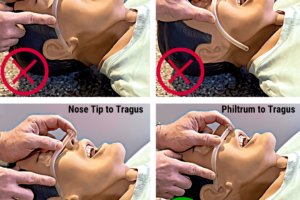 4 diagrams showing the relative measurements of an NPA against different facial anatomical structures