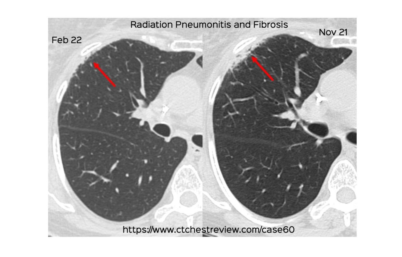 Radiation Fibrosis Lung