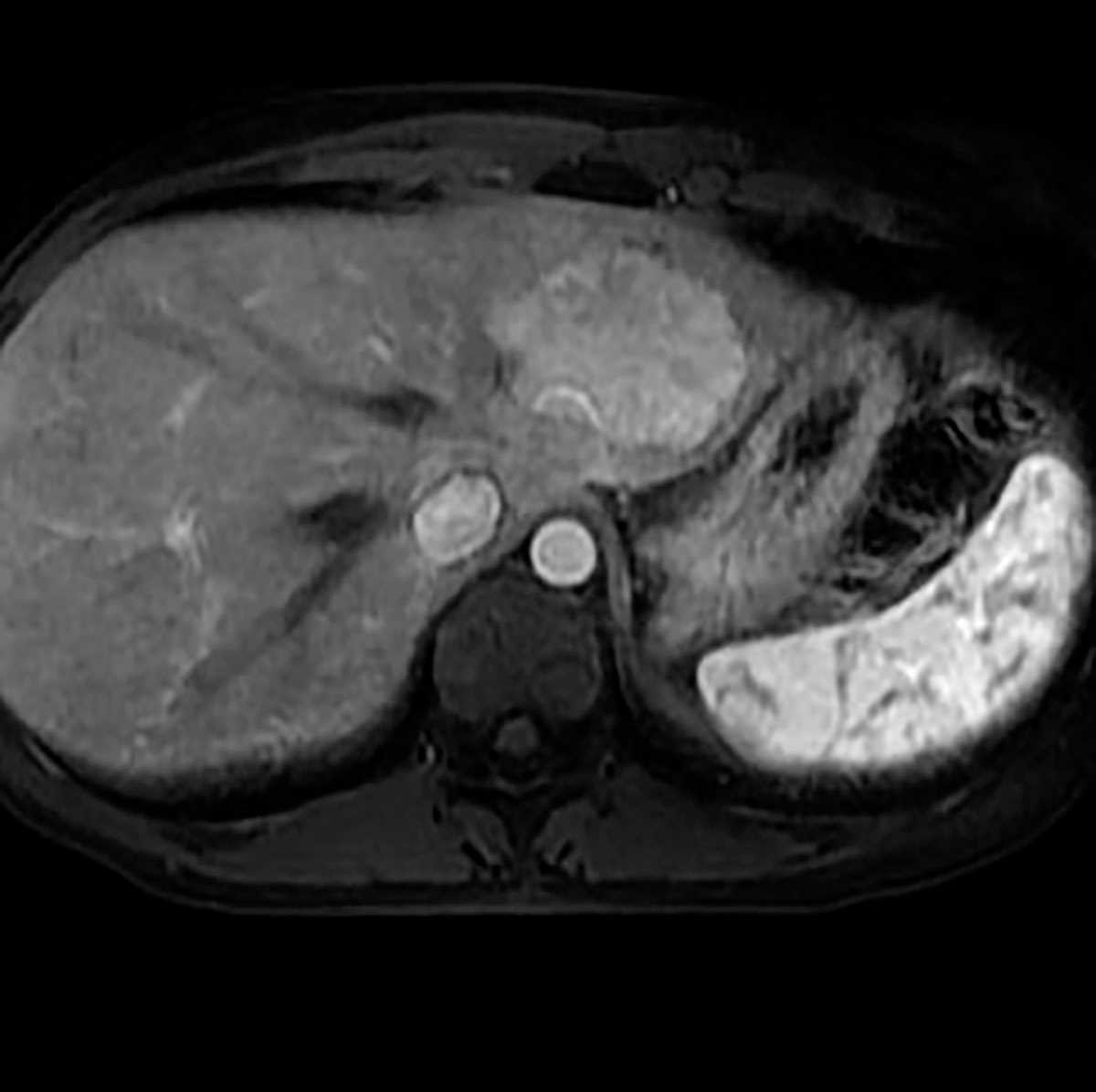 Focal nodular hyperplasia - CTisus CT Scan