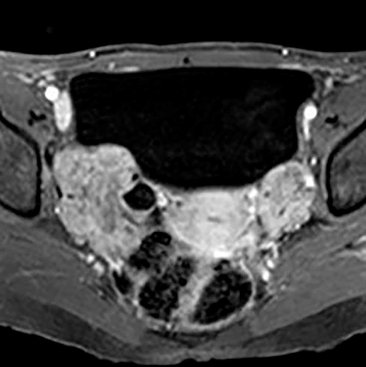 Krukenberg tumors of ovaries - CTisus CT Scan